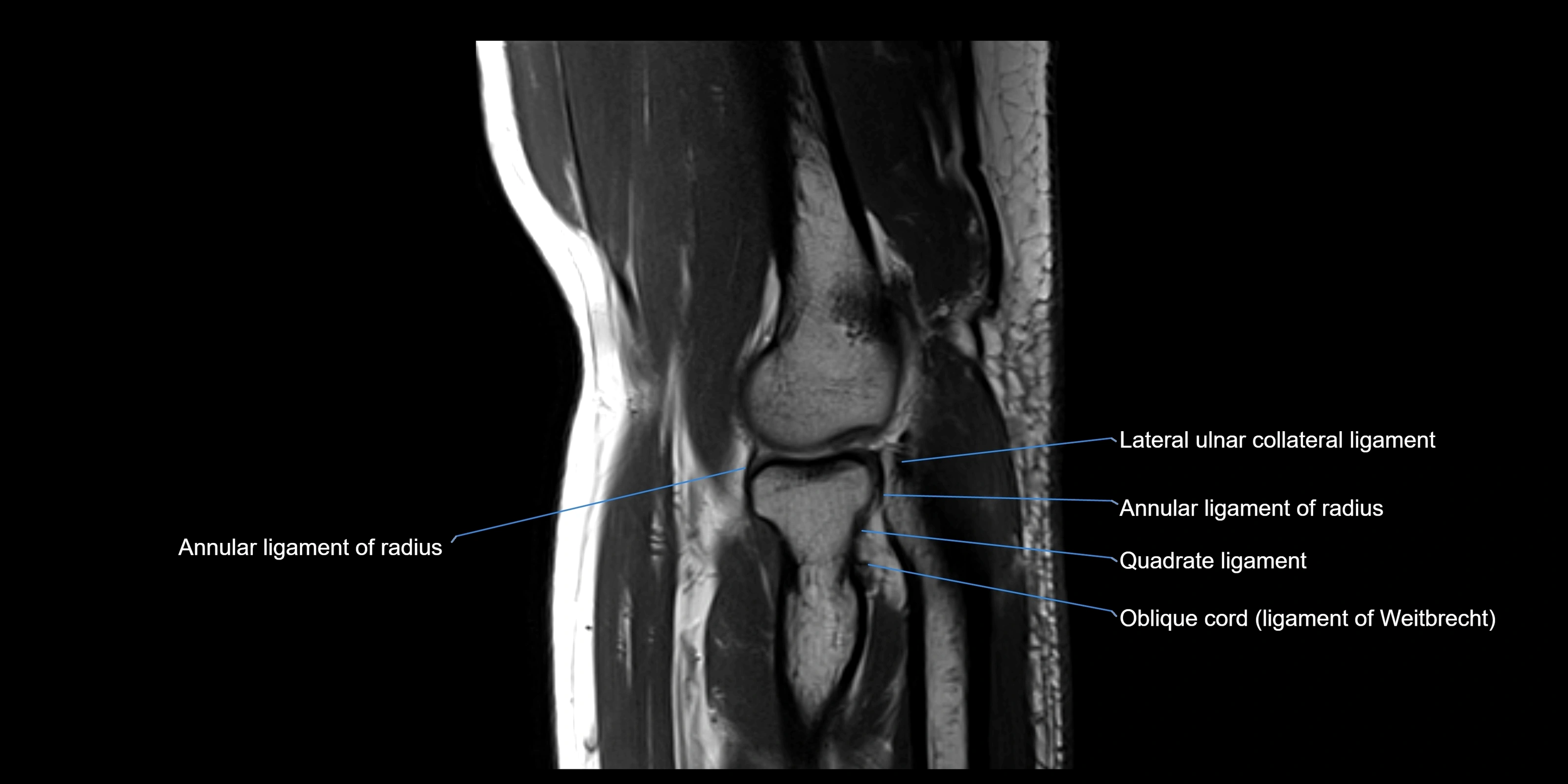 MRI elbow sagittal cross sectional anatomy 3T radiology  image-img-00001-00016.webp